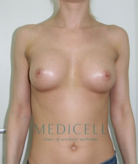 Трансаксилярное эндопротезирование груди