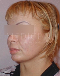 Подтяжка лица с пластикой SMAS и Platysma, верхняя и нижняя блефаропластика, липопластика лица