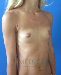Эндопротезирование груди