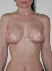 Подтяжка груди, эндопротезирование груди