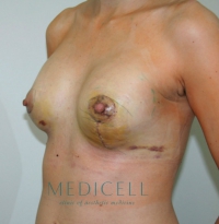 Вертикальная подтяжка груди, эндопротезирование груди
