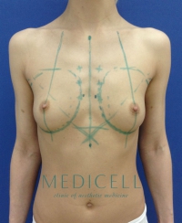 эндопротезирование груди трансаксилярный доступ, разметка.
