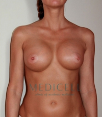 эндопротезирование груди, трансаксилярный доступ.