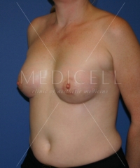 Эндопротезирование груди, периареолярная подтяжка груди.